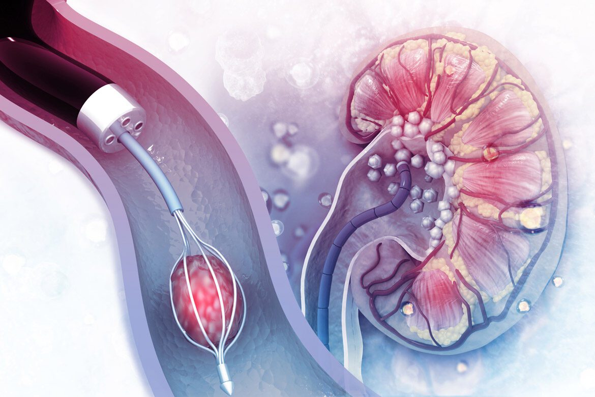 Kidney-Procedure-Illustration