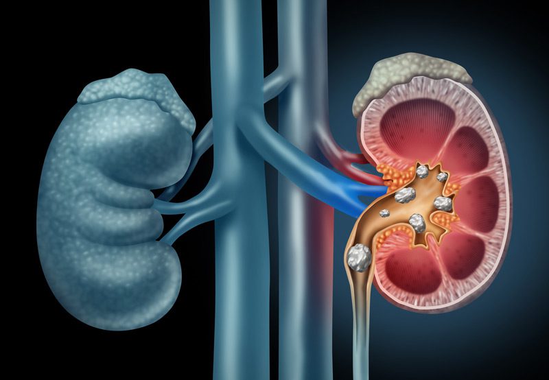 Digital-illustration-of-kidney-stones