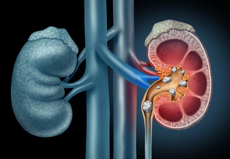 Illustration-of-kidney-stones