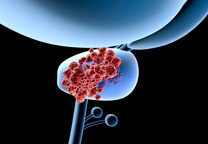 Illustration-of-prostate-gland-with-cancerous-cells