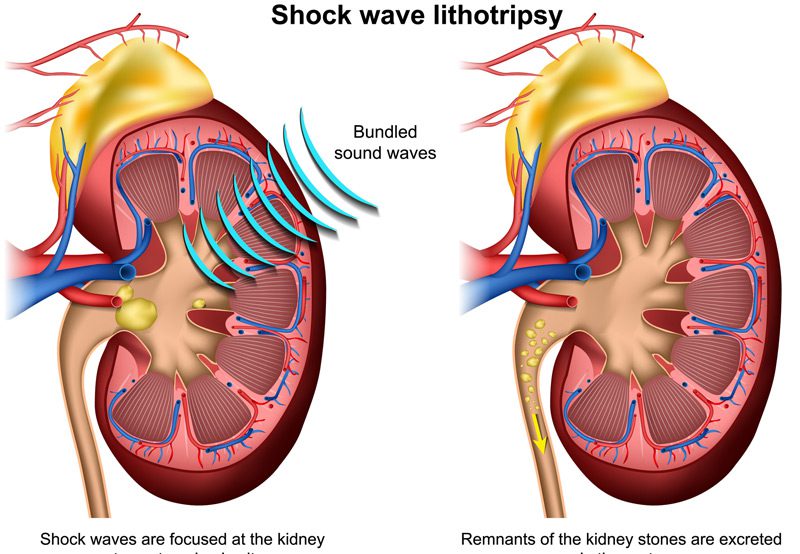 Illustration-of-shock-wave-lithotripsy-kidney-stone-disease-treatment