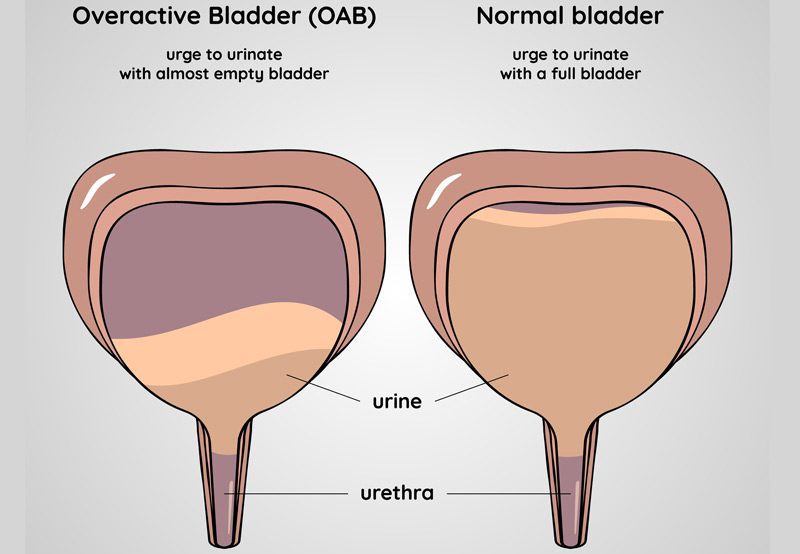Medical-illustration-of-normal-and-overactive-bladder