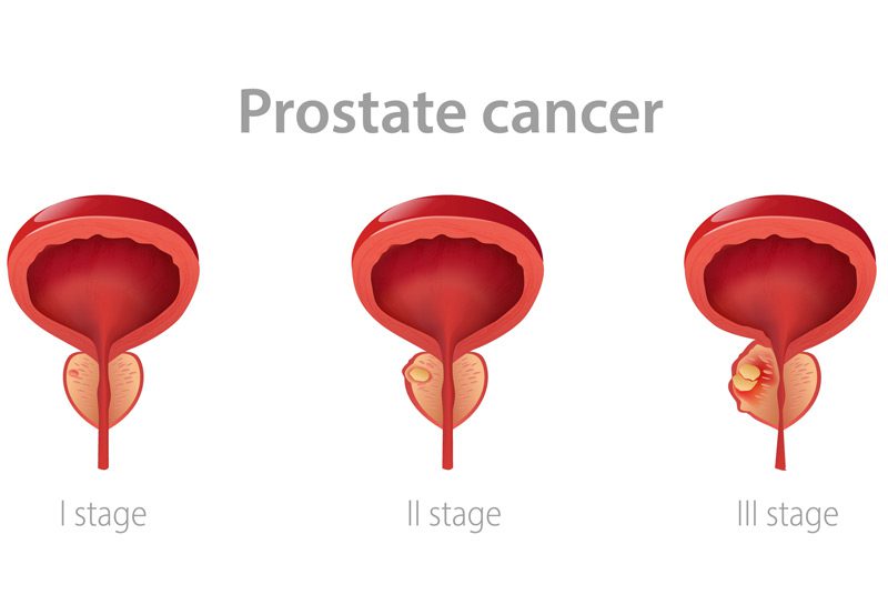 Medical-illustration-of-prostate-cancer-in-various-stages